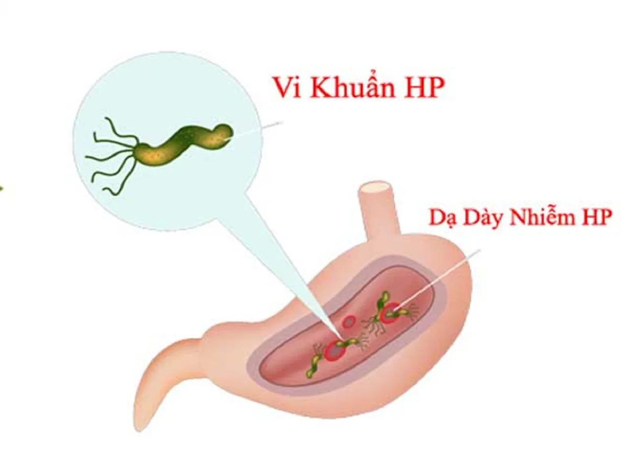 tim-hieu-vi-khuan-hp-da-day-la-gi-a1a